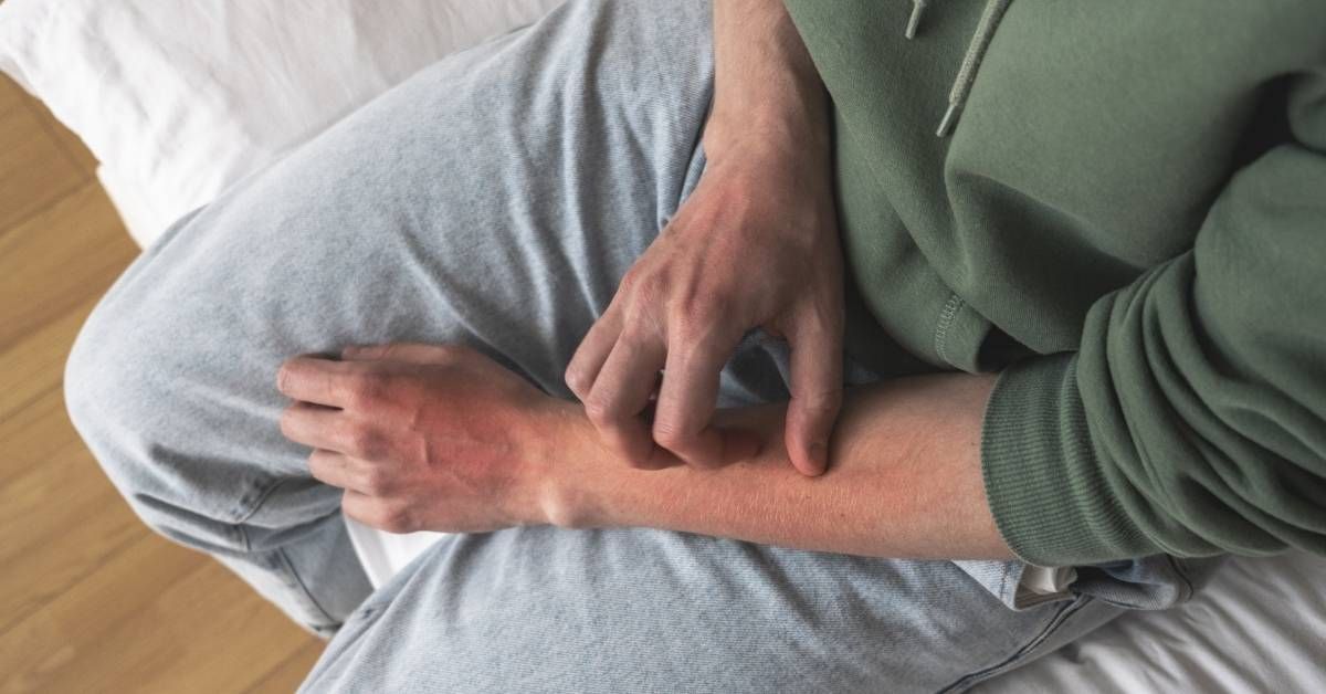 Dermatillomania cos'è e sintomi: escoriazione compulsiva.