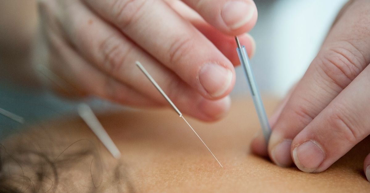 L’agopuntura aiuta a smettere di fumare