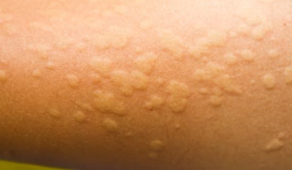 Orticaria da stress pomfi sul braccio