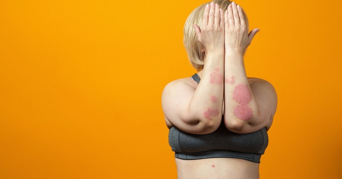 Psoriasi cause