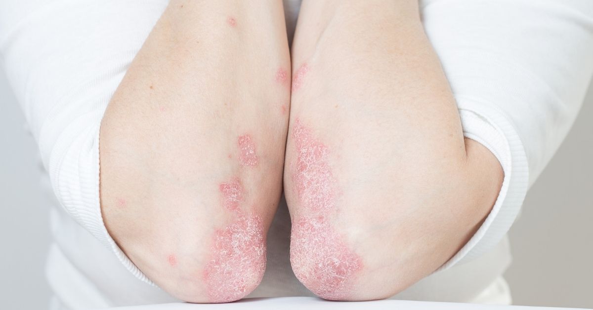 Psoriasi come si manifesta