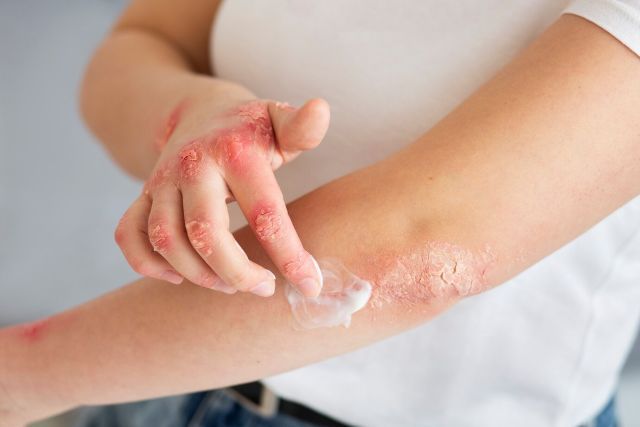 Qual è la miglior cura per la psoriasi