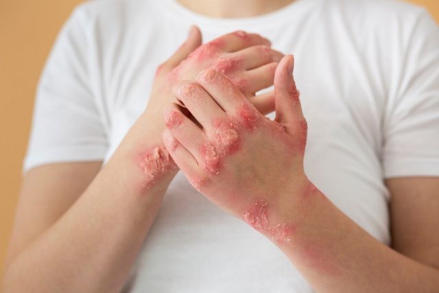 Quali sono le cause della psoriasi da stress