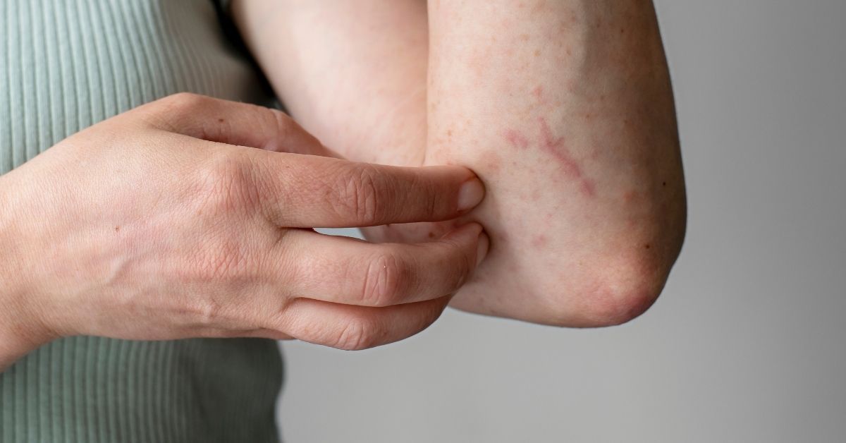 Sintomi della dermatite da stress.