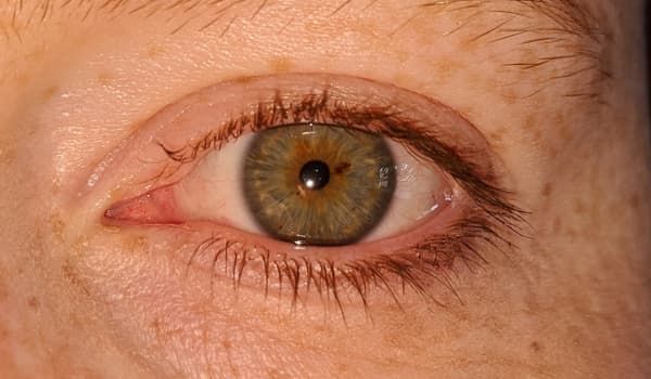 Stress e lampi di luce negli occhi