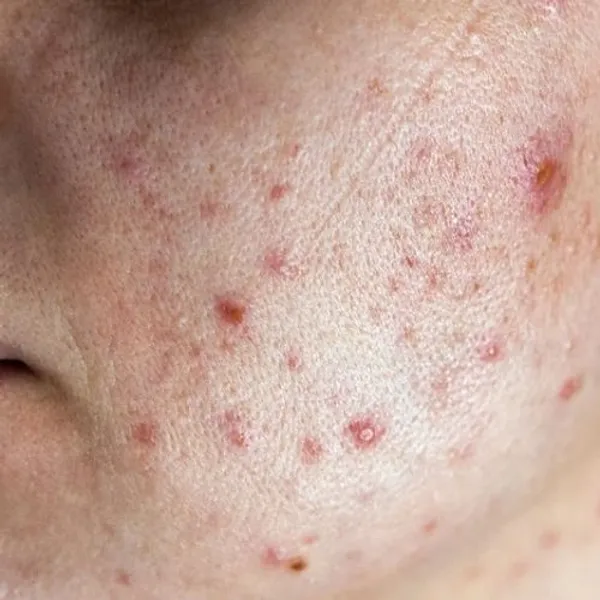Primo piano di pelle del viso con acne e arrossamenti