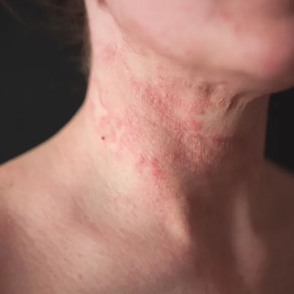 Cos'è la dermatite psicosomatica da stress