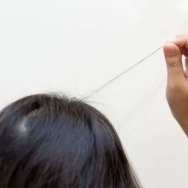 Perdita dei capelli in adolescenza