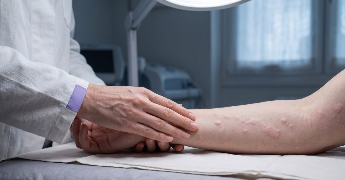 Pomfi da orticaria causati dallo stress sulla pelle del braccio
