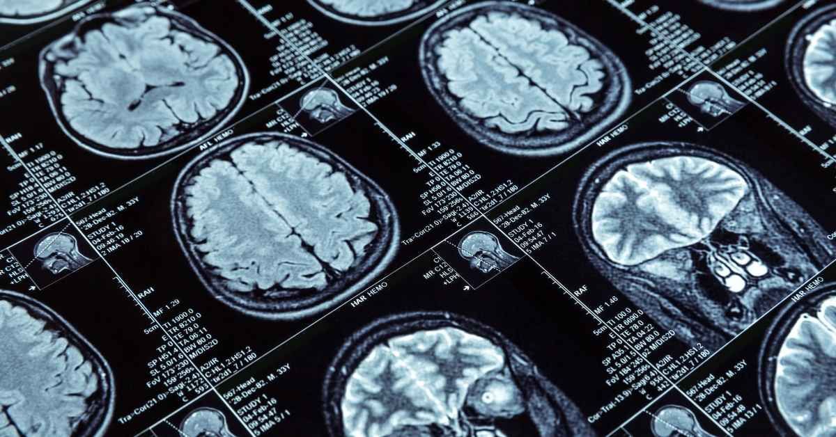 Risonanza magnetica prescritta dal neurologi